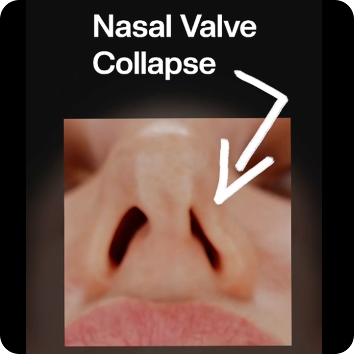 Halune Nasal Dilator