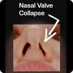 Halune Nasal Dilator